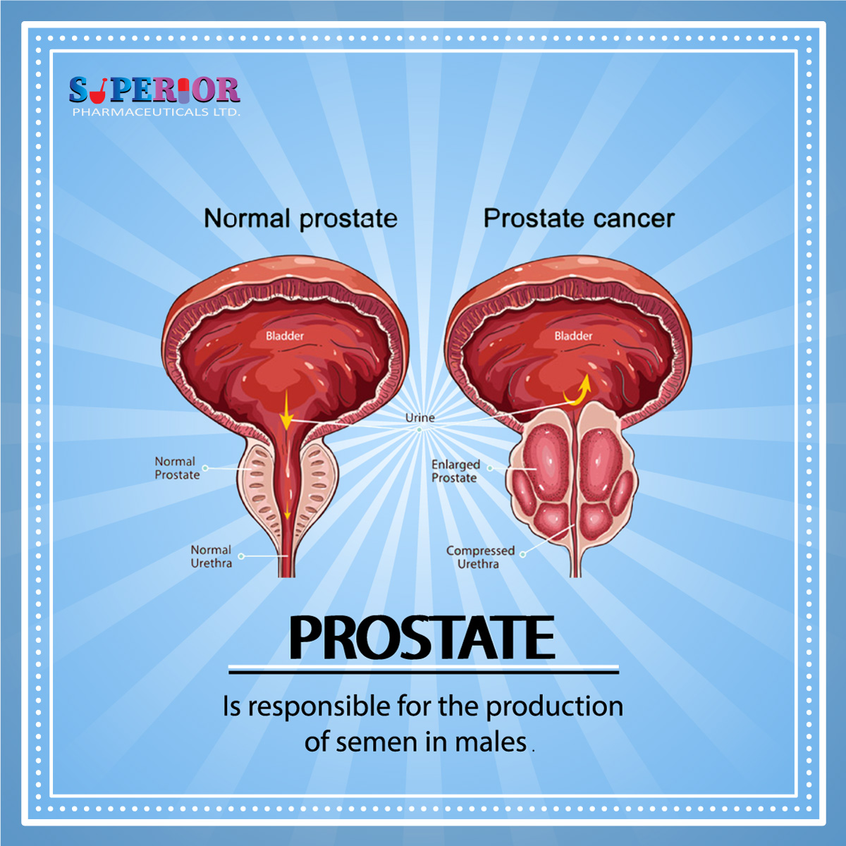 Enlarged Prostate Cancer